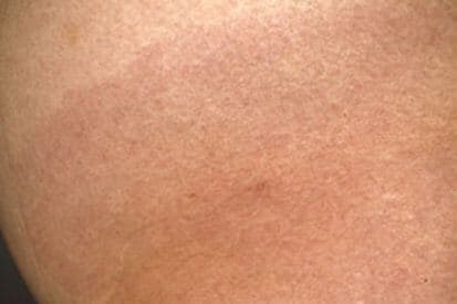 Lyme-Disease-rash
