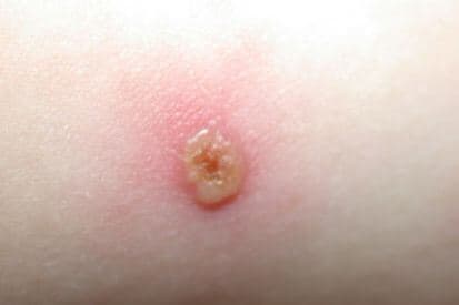 example-of-chicken-pox