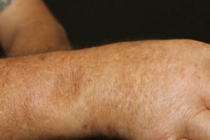 pinnacleskin.com /conditions/scleroderma Carousel 1 Image 3