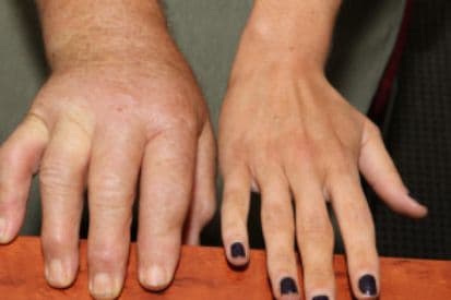 pinnacleskin.com /conditions/scleroderma Carousel 1 Image 4