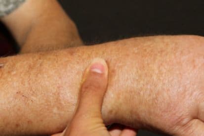 pinnacleskin.com /conditions/scleroderma Carousel 1 Image 2