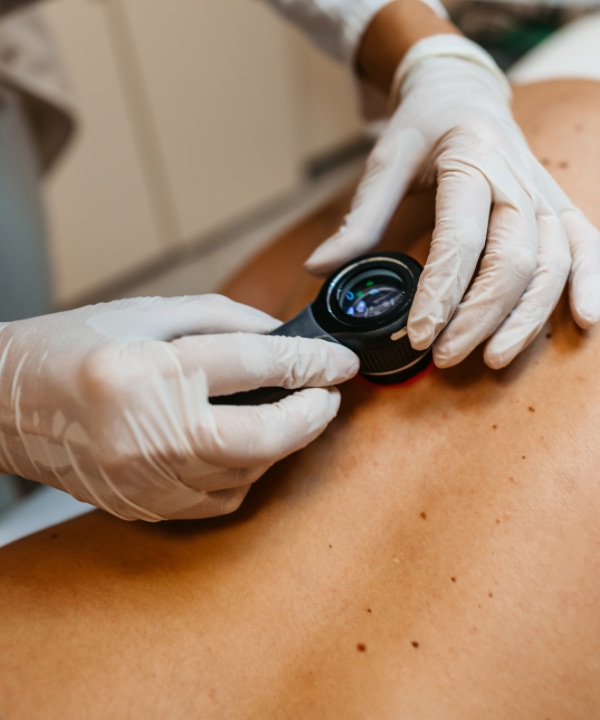 Man getting mole examined on his back