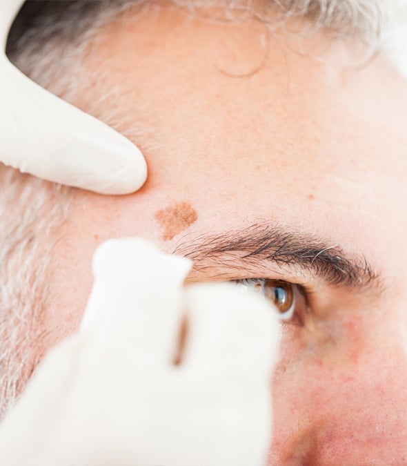 Dermatologist Removing Skin Cancer From A Patient's Face