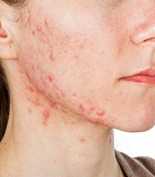 A Woman With Facial Acne