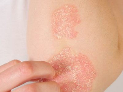 Psoriasis On A Patient's Elbow