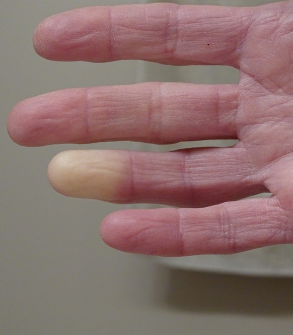 A patient with Scleroderma on their finger
