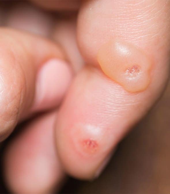A Patient With Blisters On Their Fingers