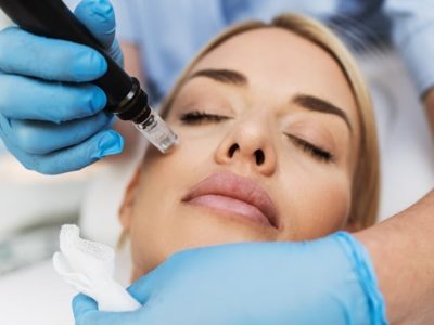A Dermatologist Microneedling A Woman's Face