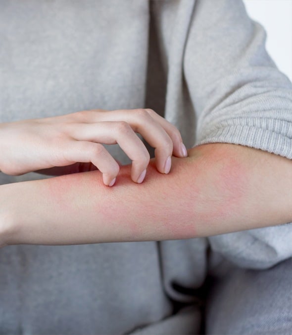 A Woman Scratching A Rash On Her Arm