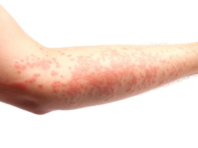 Psoriasis On A Patient's Arm