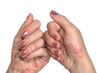 Psoriasis On A Patient's Hands