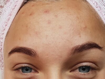 A Woman With Acne On Her Forehead