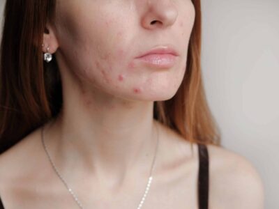A Woman With Acne