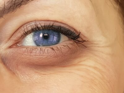 The Lines Around A Woman's Eyes Before Botox Treatment