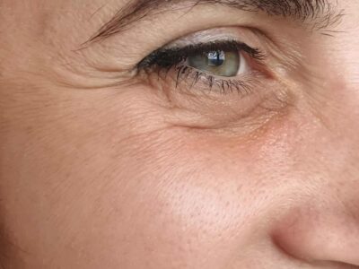 A Middle-aged Woman's Face Before Receiving Botox Treatment