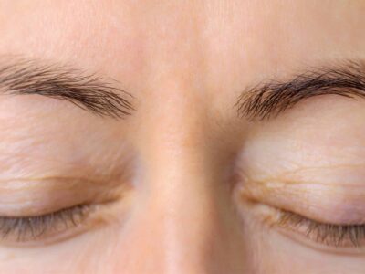 After Look At A Woman's Brow Who Received Botox Treatment