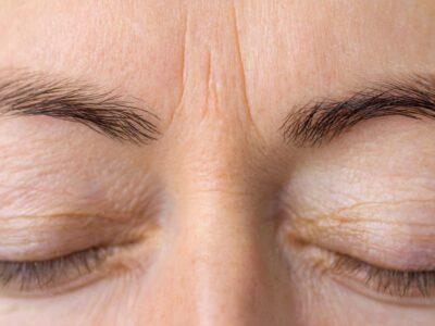 Before Look At A Woman's Brow Ahead Of Her Botox Treatment