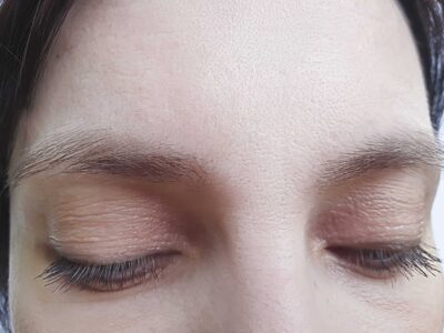 A Woman's Forehead Wrinkles After Being Treated With Dermal Fillers