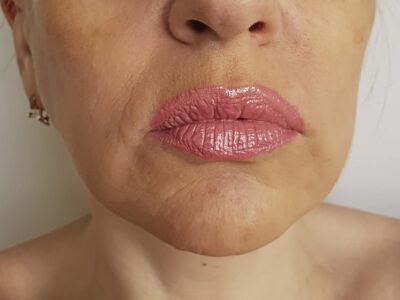 Woman's Facial Wrinkles Before Dermal Fillers Treatment