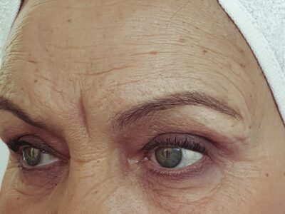 An Elderly Woman's Forehead Wrinkles Before Dermal Fillers Treatment