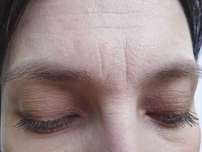 A Woman's Forehead Wrinkles Before Treatment