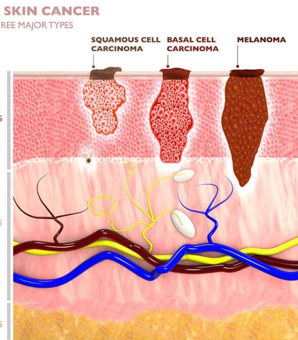 A diagram showing how skin cancer forms